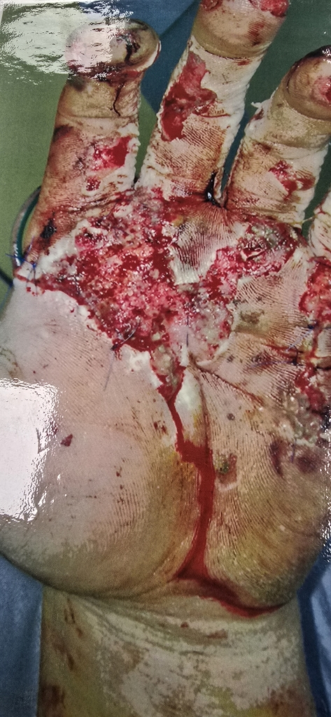 Slika okrvavljene, poškodovane roke zaradi uporabe pirotehnike